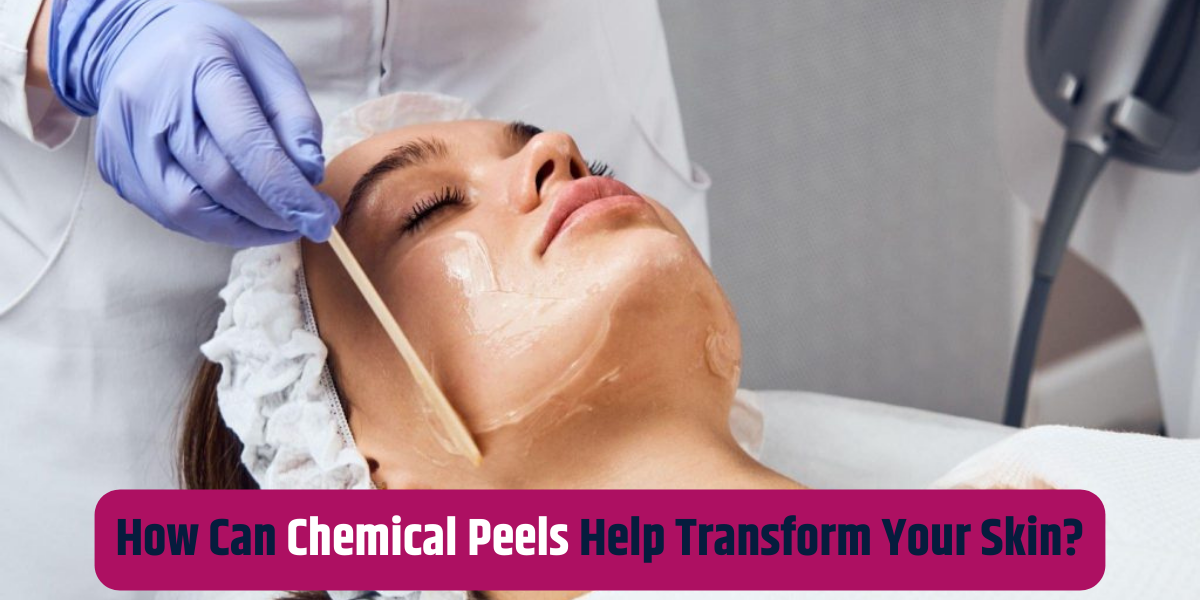 How Can Chemical Peels Help Transform Your Skin?