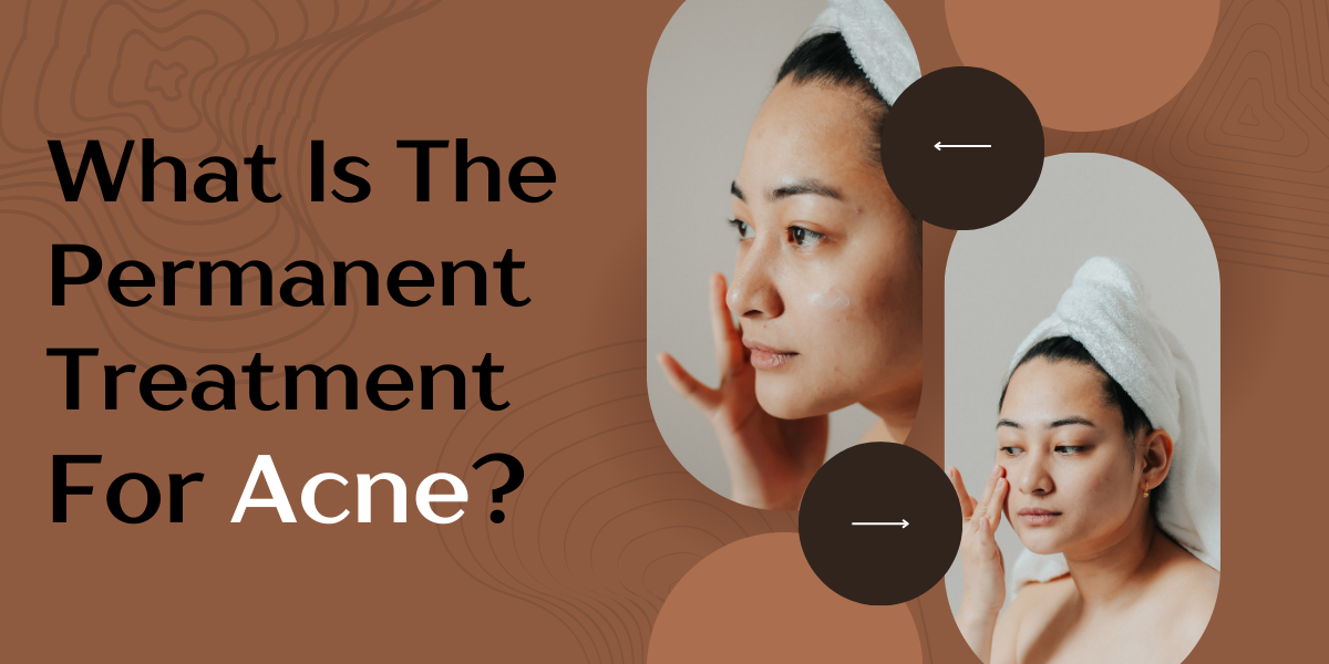 What is the permanent treatment for acne?