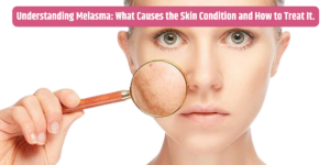 Understanding Melasma: What Causes the Skin Condition and How to Treat It.