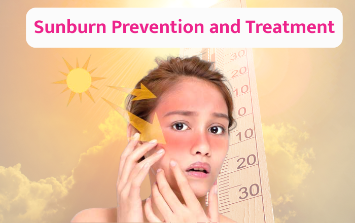 How to Prevent and Treat Sunburn in Summer