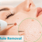 Laser Mole Removal: Procedure, Cost & Recovery Explained