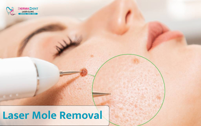 Laser Mole Removal: Procedure, Cost & Recovery Explained