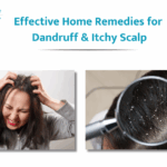 Home Remedies for Dandruff and Itchy Scalp: What Works