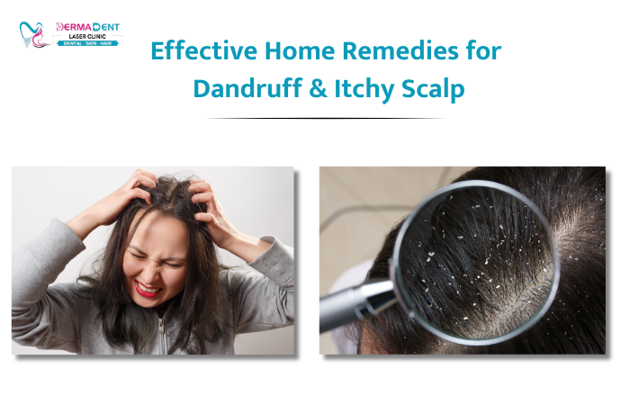 Home Remedies for Dandruff and Itchy Scalp: What Works?