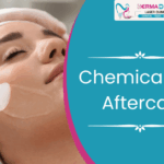 Chemical Peel Aftercare: What to Do and Avoid