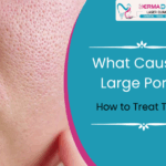 What Causes Large Pores and How to Treat Them Effectively