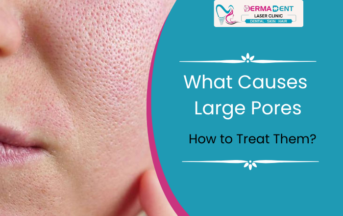 What Causes Large Pores and How to Treat Them Effectively