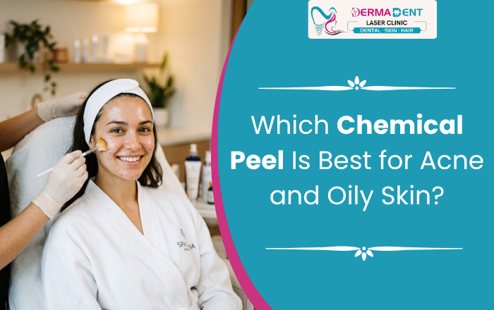 Which Chemical Peel Is Best for Acne and Oily Skin